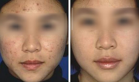 激光祛痘多少钱能做完?